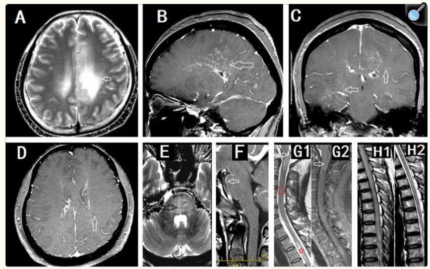 Astrocitopatía Glial Fibrilar